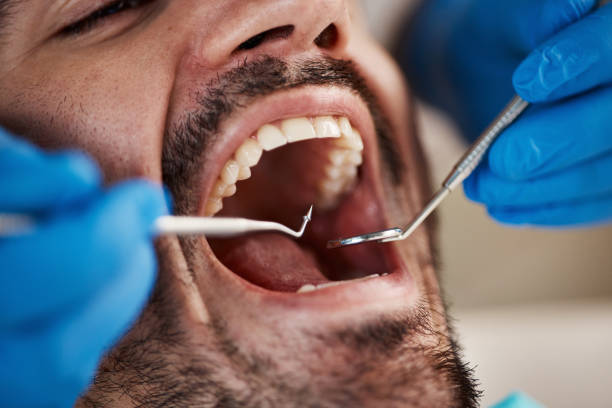 Best Emergency Dental Care for Broken or Chipped Teeth in Staunton, VA